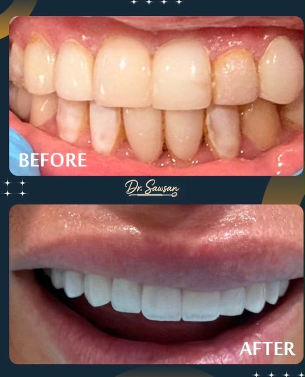 Smile transformation by Dr. Sawsan Awartani — before and after