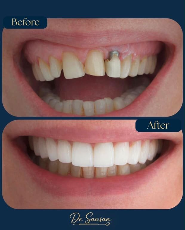 Smile transformation by Dr. Sawsan Awartani — before and after