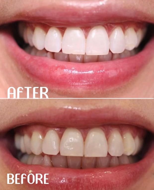 Smile transformation by Dr. Sawsan Awartani — before and after