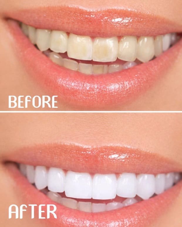 Smile transformation by Dr. Sawsan Awartani — before and after